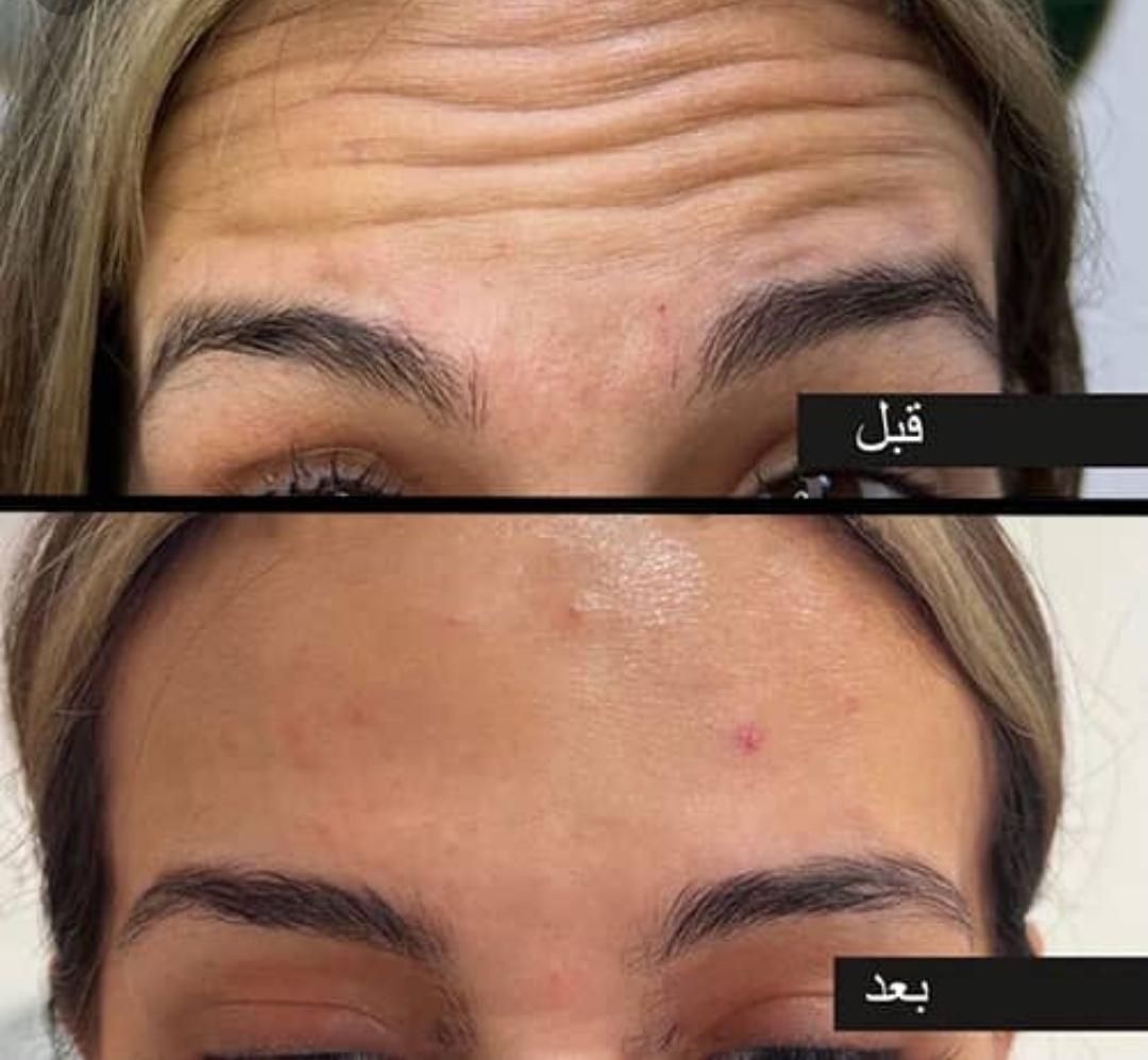 چربی بوتاکس ساکشن غبغب ژل مزو PRPتوسط پزشک مجرب|خدمات آرایشگری و زیبایی|زاهدان, |دیوار