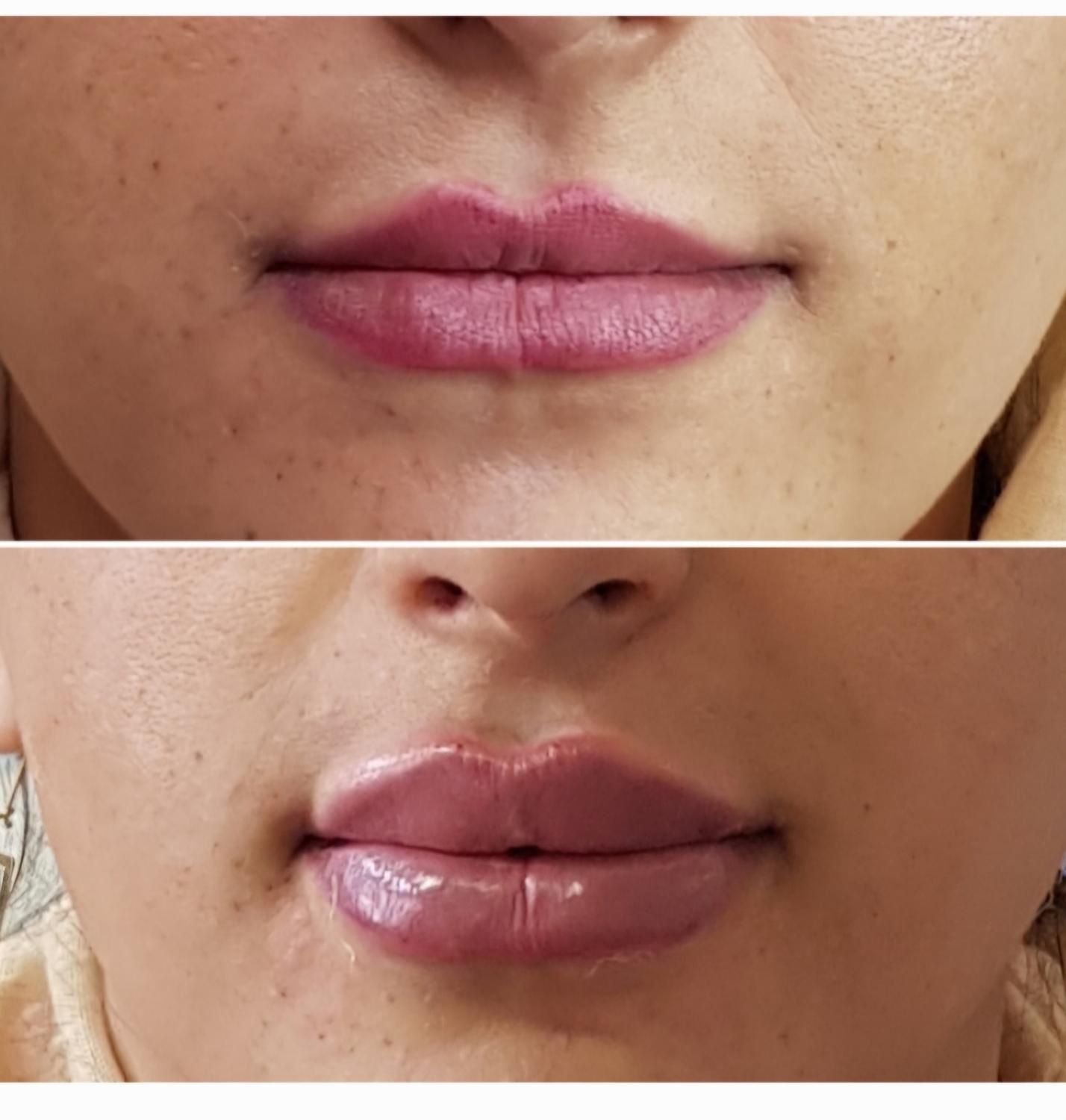 بوتاکس ژل فیلر مزوتراپی لیزر هایفو لیفت نخ در مطب|خدمات آرایشگری و زیبایی|اصفهان, مسجد مصلی|دیوار