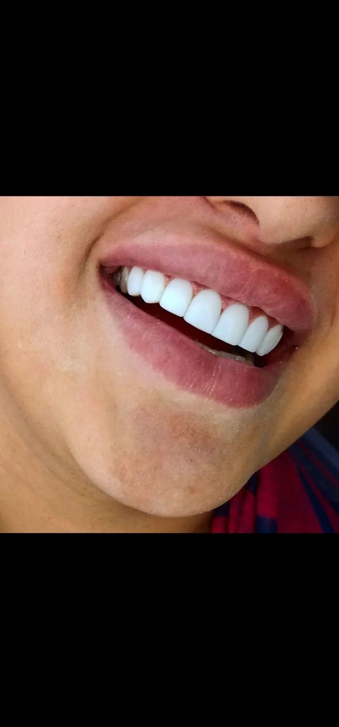 کامپوزیت زیبایی دندانپزشکی|خدمات آرایشگری و زیبایی|یاسوج, |دیوار