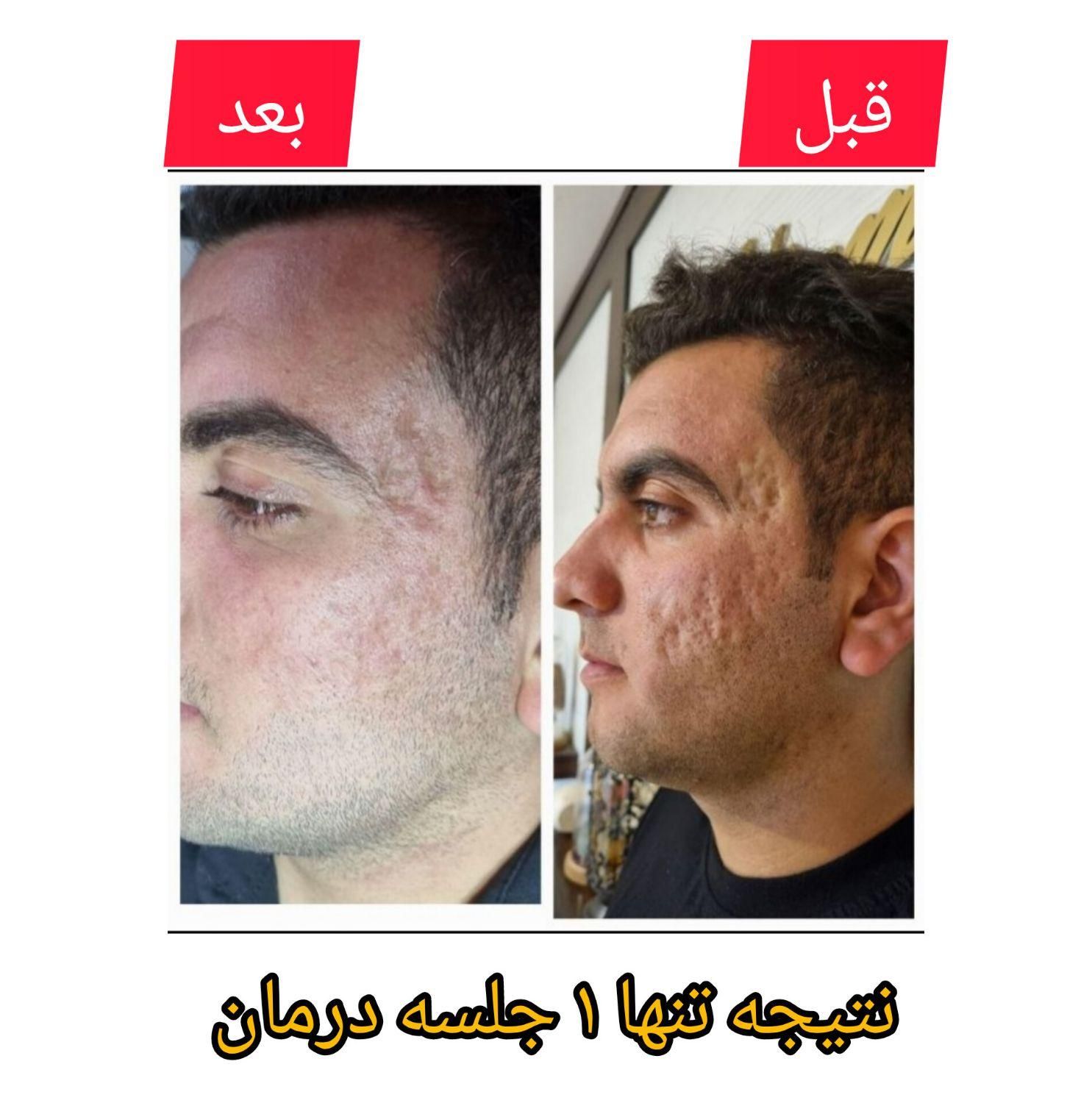 درمان تضمینی وماندگار تو رفتگی پوستی/جای جوش/اسکار|خدمات آرایشگری و زیبایی|اصفهان, باغ دریاچه|دیوار