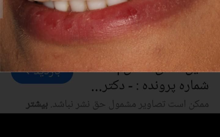 عصب کشی دندان (۱۲۰۰) دندانپزشکی تعرفه دولتی|خدمات آرایشگری و زیبایی|کرج, برغان|دیوار