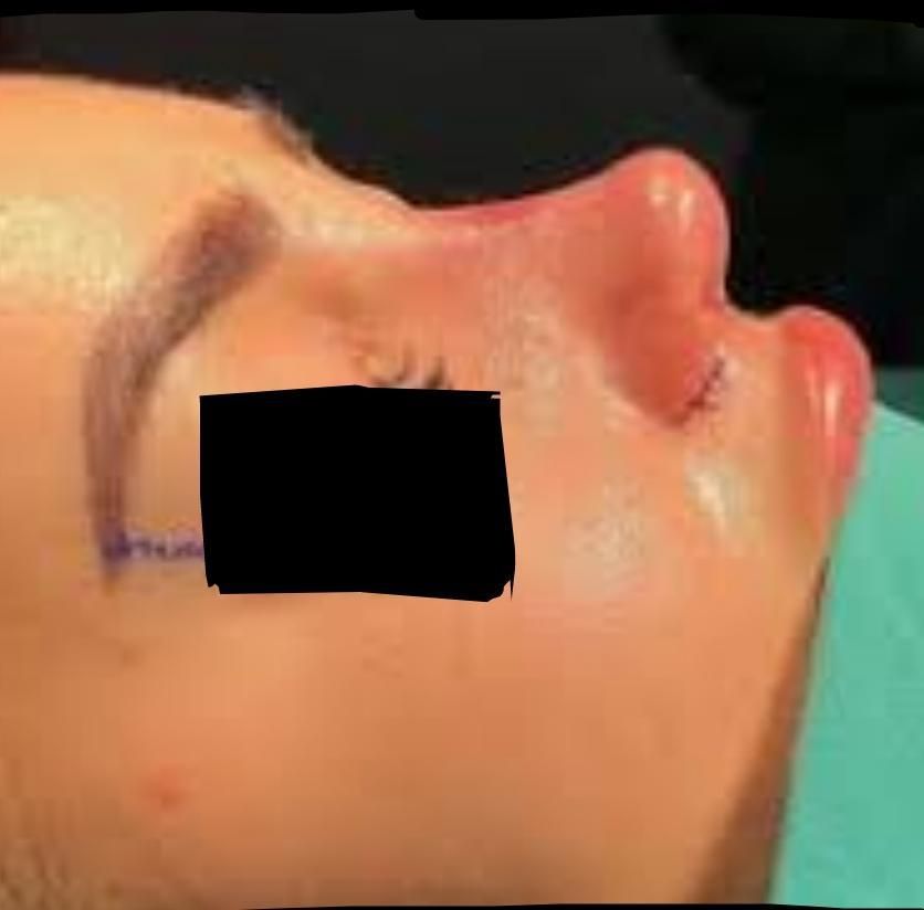 جراحی زیبایی بینی (جشواره)|خدمات آرایشگری و زیبایی|تهران, صادقیه|دیوار