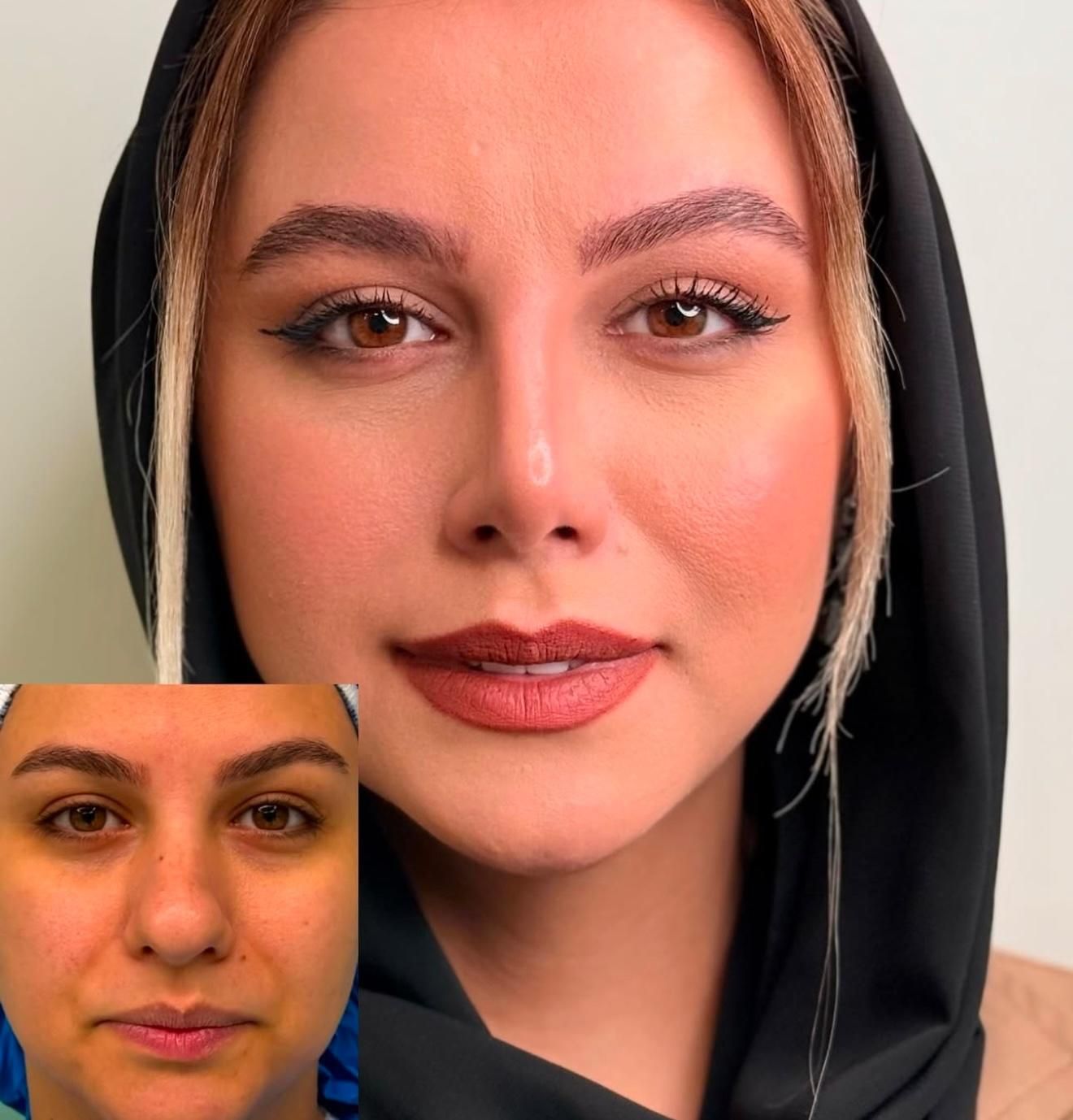 جراحی زیبائی بینی عمل بینی لیفت شقیقه پلک گوش غبغب|خدمات آرایشگری و زیبایی|اصفهان, مرداویج|دیوار