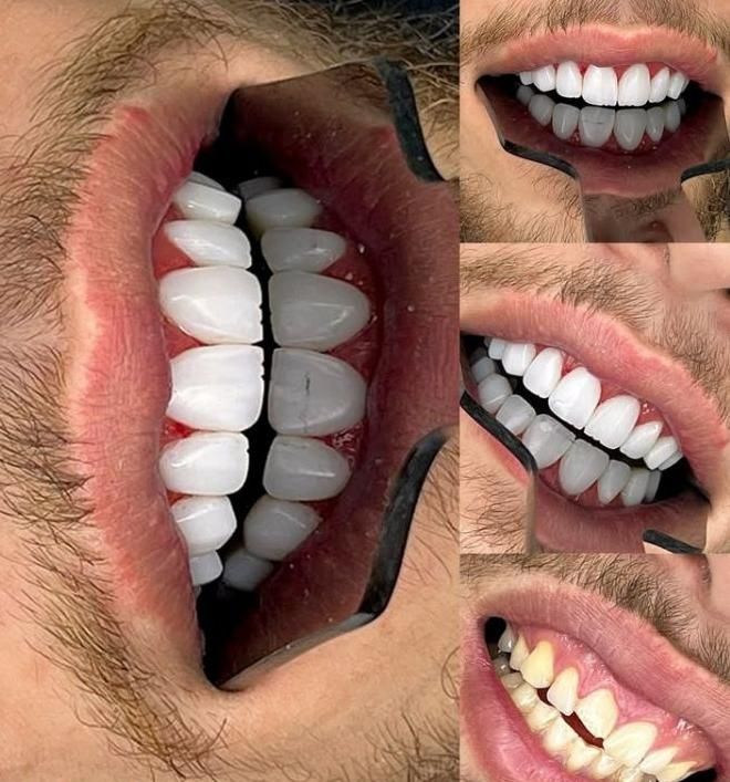 کامپوزیت/لمینت/ایمپلنت/روکش|خدمات آرایشگری و زیبایی|تهران, ستارخان|دیوار