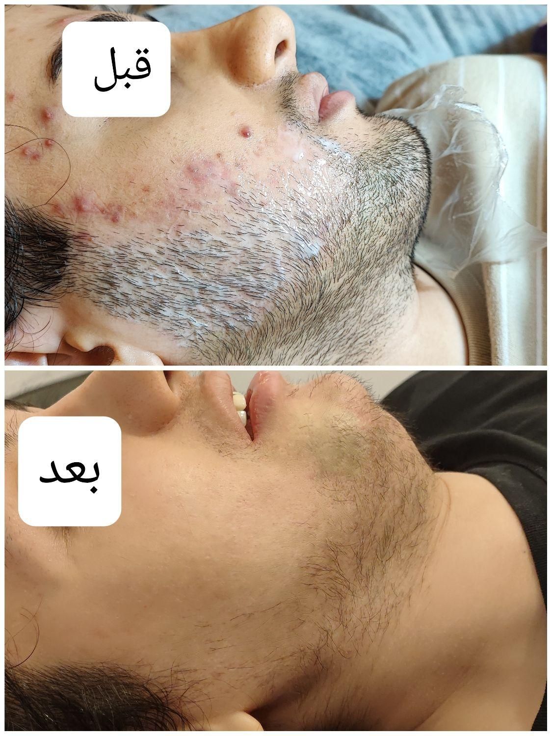 الکترولیز موهای سفیدمشکی خانم وآقا(متفاوت با لیزر)|خدمات آرایشگری و زیبایی|بندر ماهشهر, |دیوار
