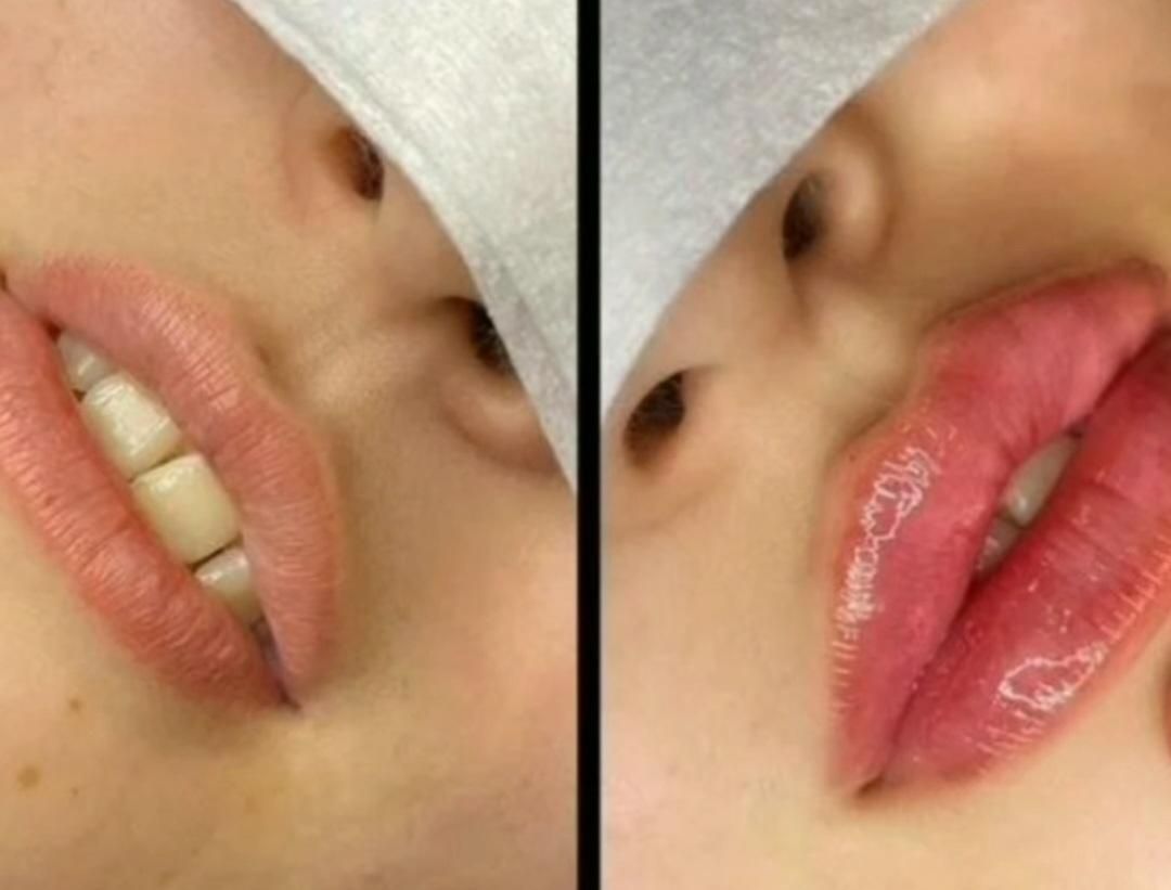 تزریق ژل لب صورت فیلر بوتاکس میکرونیلدینگ مزوتراپی|خدمات آرایشگری و زیبایی|شیراز, شهرک گلستان|دیوار