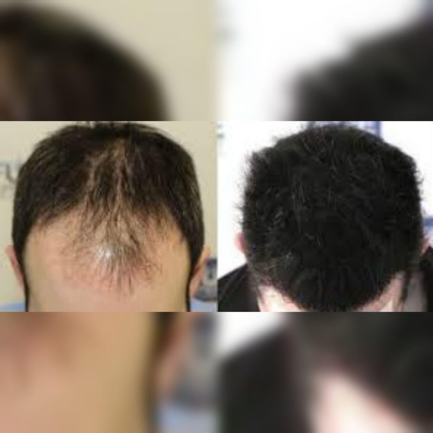 کاشت مو و ابرو تیم شیرازی در قزوین ، جشنواره اقساط|خدمات آرایشگری و زیبایی|قزوین, |دیوار