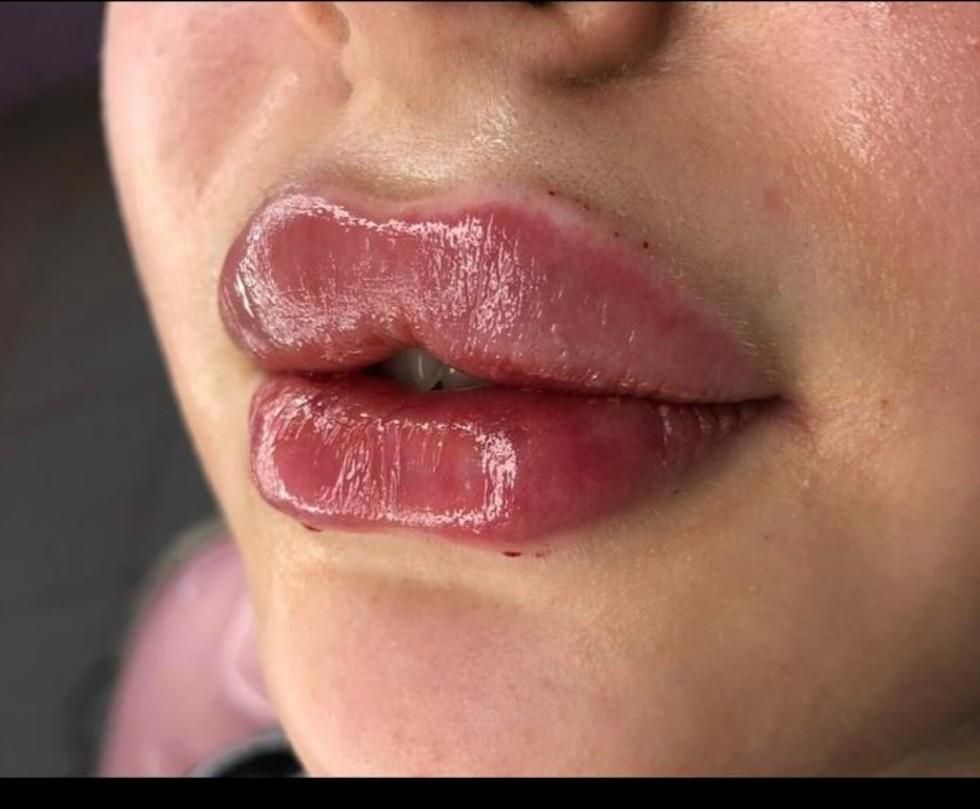 ژل و بوتاکس و لیفت نخ مزوتراپی و آنزیم.فیلربادی|خدمات آرایشگری و زیبایی|کرج, مهرویلا جنوبی|دیوار
