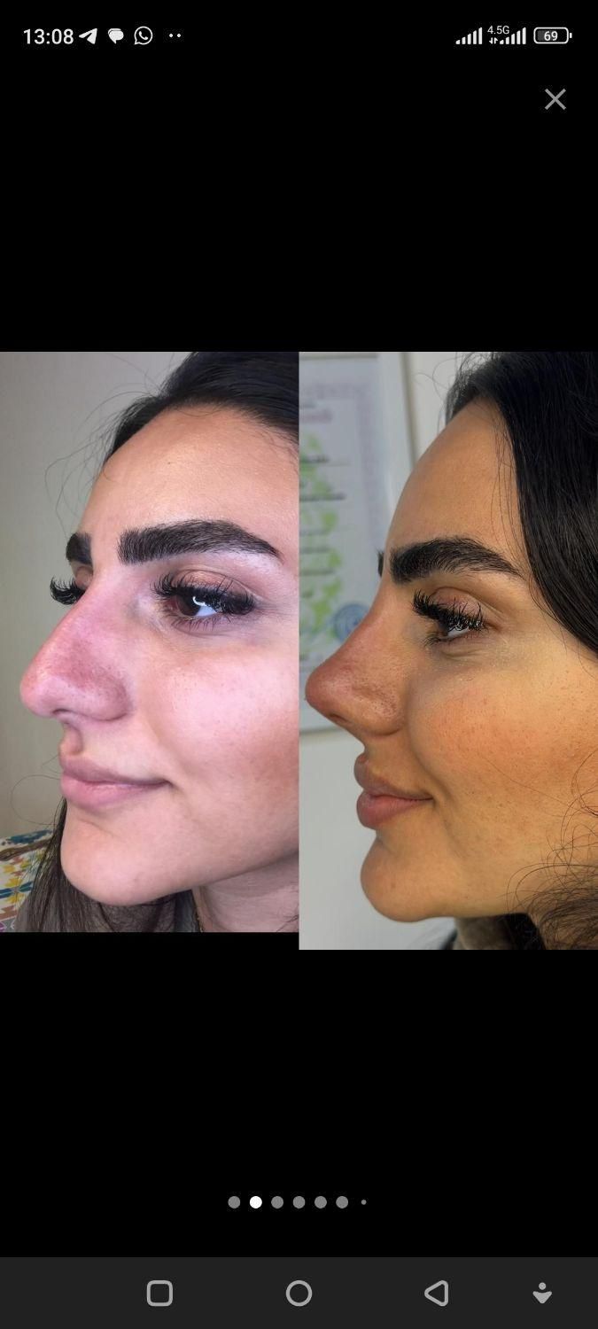 لیفت بینی بانخ|خدمات آرایشگری و زیبایی|تبریز, |دیوار