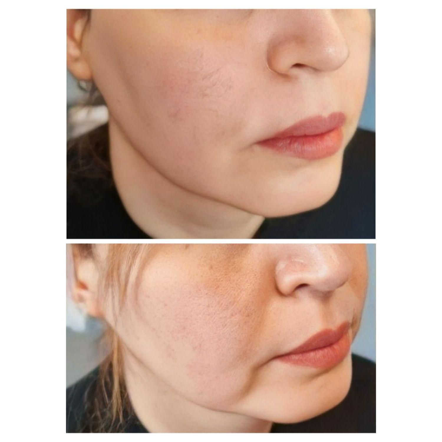 هایفو / لیفت صورت (شوش)|خدمات آرایشگری و زیبایی|شوش, |دیوار