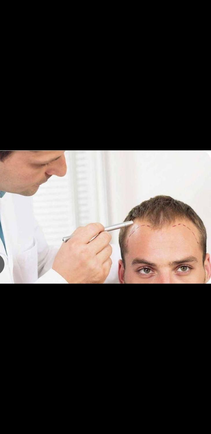 کاشت کار پس از آموزش کاشت مو یا آموزش کاشت ابرو|استخدام درمانی، زیبایی، بهداشتی|تهران, فردوس|دیوار