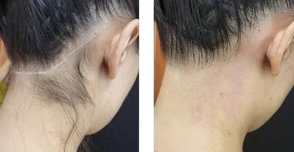 جشنواره 50% تخفیف ویژه مرکز لیزر الکس|خدمات آرایشگری و زیبایی|ساری, |دیوار