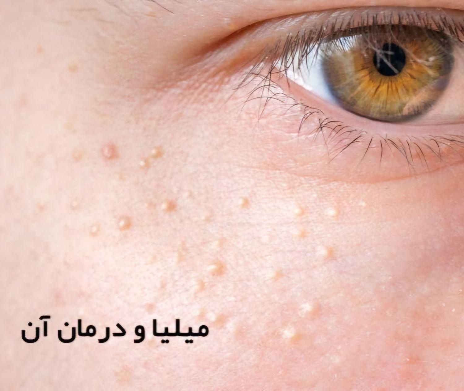 برداشتن خال زگیل میخچه باقیمت فوق العاده توسط پزشک|خدمات آرایشگری و زیبایی|اسلام‌شهر, |دیوار