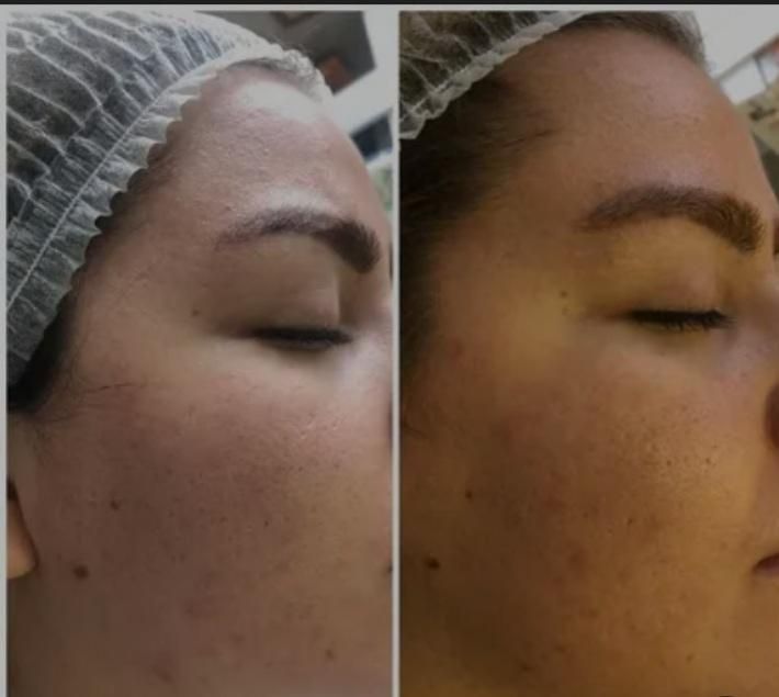 اف ویژه پاکسازی پوست|خدمات آرایشگری و زیبایی|مسجد سلیمان, |دیوار