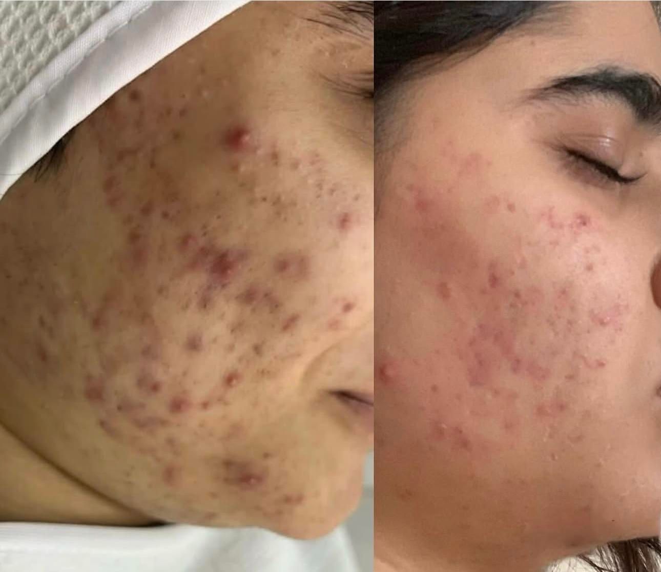 درمان مشکلات پوست مطب/مزوتراپی/فشیال/مزونیدلینگ/ژل|خدمات آرایشگری و زیبایی|مشهد, دانشجو|دیوار