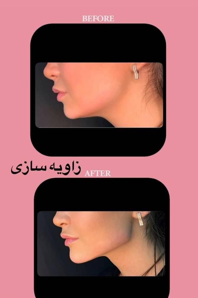 تزریق ژل لب بوتاکس هایفولیزرفیلرلیفت صورت سفیدسازی|خدمات آرایشگری و زیبایی|تهران, صادقیه|دیوار