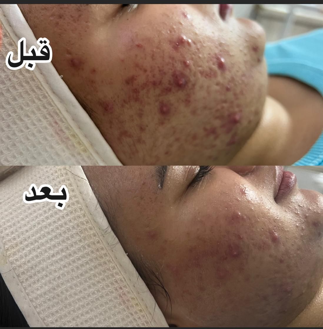 خدمات لیزر و فیشال و زیبایی|خدمات آرایشگری و زیبایی|تهران, فلسطین (میدان انقلاب)|دیوار