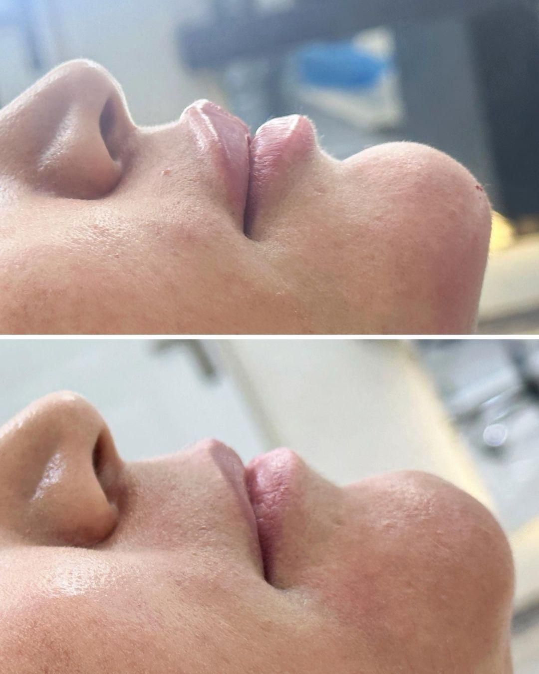 ژل /بوتاکس فیلر لب روسی اموزش بوتاکس آنزیم چربی|خدمات آموزشی|خرم‌آباد, |دیوار