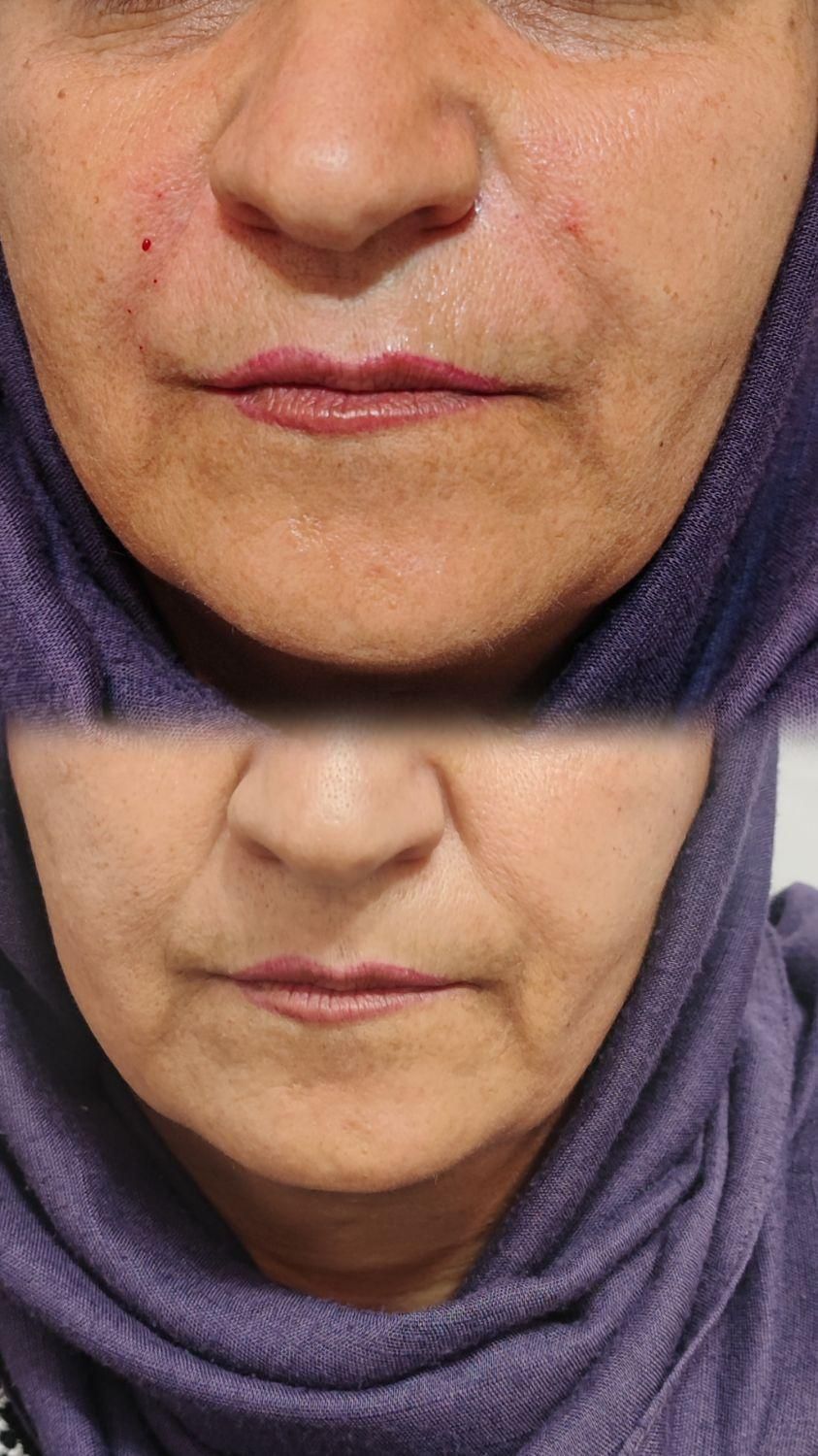 ژل خط خنده ( شوش)|خدمات آرایشگری و زیبایی|شوش, |دیوار