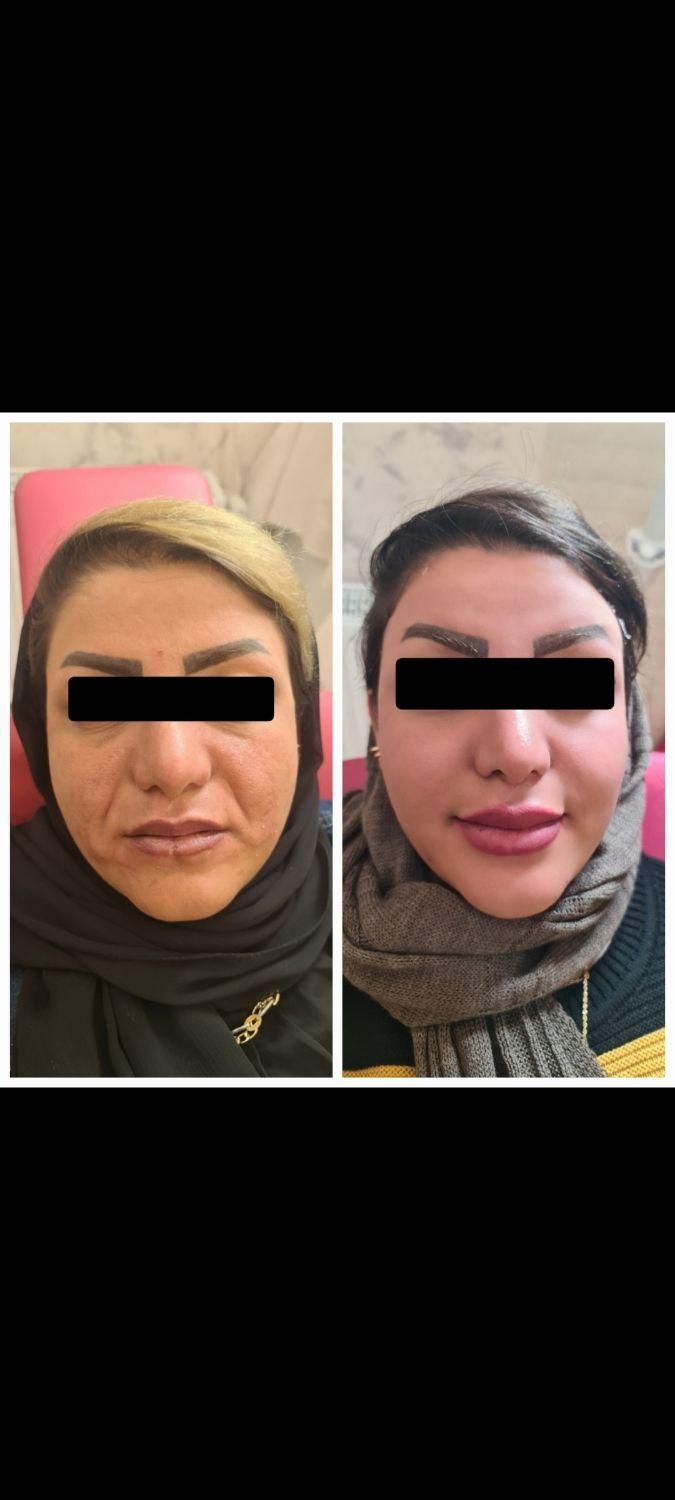 تزریق ژل لب و گونه و چانه و..(جشنواره)درمطب|خدمات آرایشگری و زیبایی|اصفهان, ملک‌شهر|دیوار