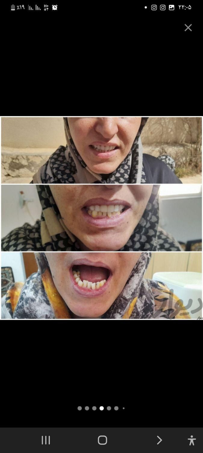 تعمیر و ساخت دندان‌های مصنوعی متحرک|خدمات آرایشگری و زیبایی|سمنان, |دیوار