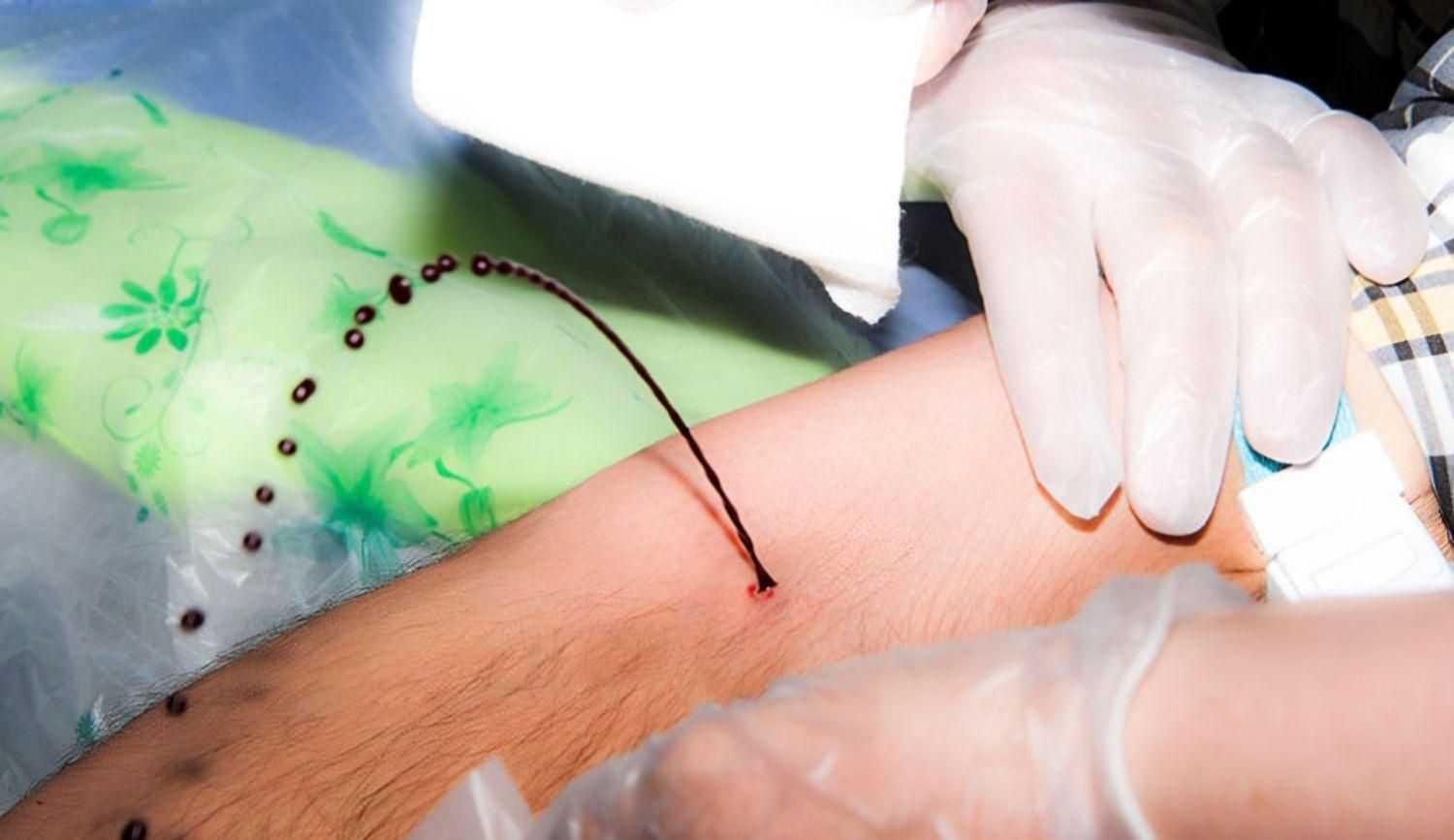 زالو،حجامت،فصد خون،مشاوره طب سنتی عباسیه نجف آباد|خدمات آرایشگری و زیبایی|یزد, |دیوار