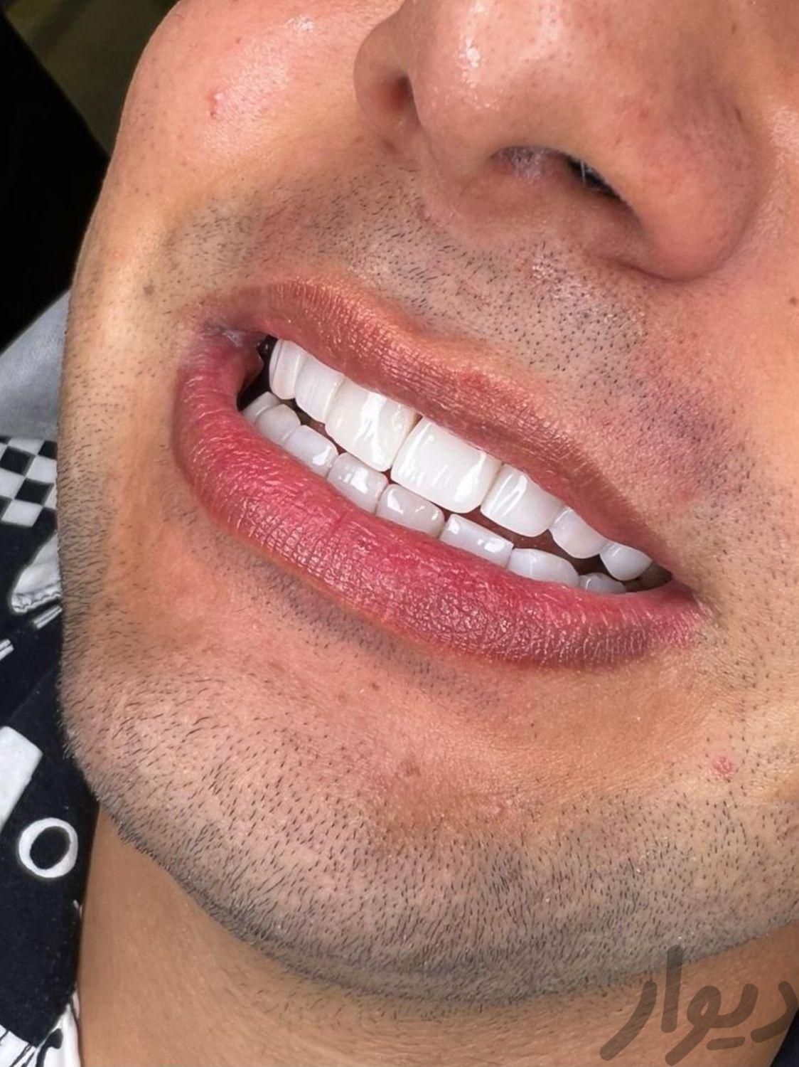 کامپوزیت دندان عصب کشی ایمپلنت دندانپزشکی پالیش|خدمات آرایشگری و زیبایی|تهران, میرداماد|دیوار