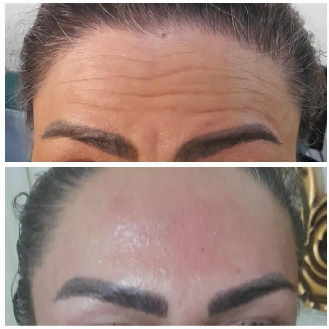 افر ویژه‌ی فیلر/بوتاکس/prpبا قیمت باورنکردنی|خدمات آرایشگری و زیبایی|تهران, دروازه شمیران|دیوار