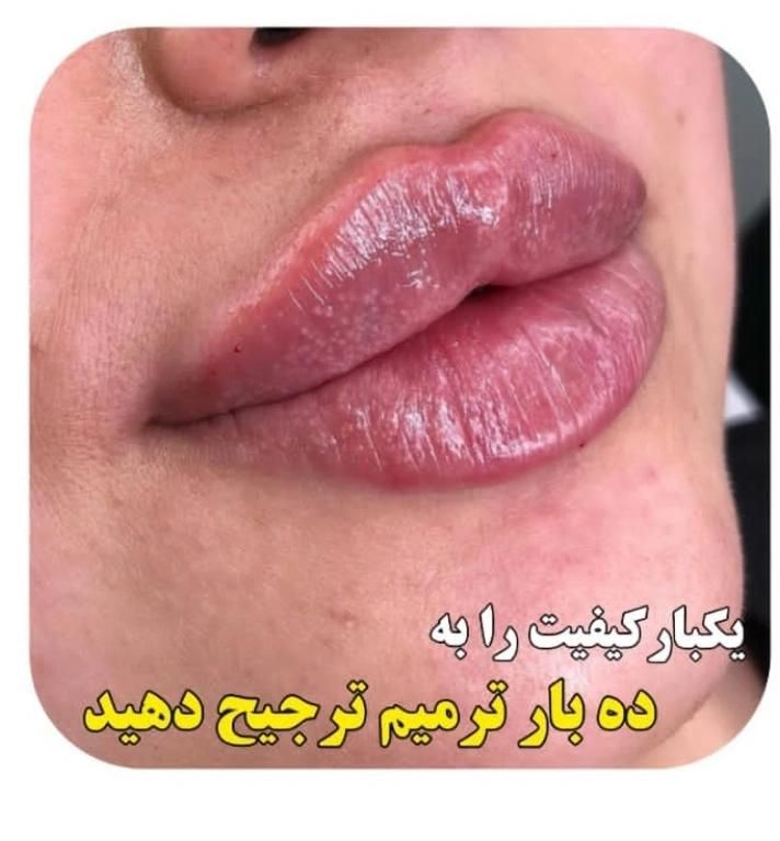 جشنواره ژل لب روسی زاویه سازی فیلر لب بوتاکس و...|خدمات آرایشگری و زیبایی|شهریار, |دیوار