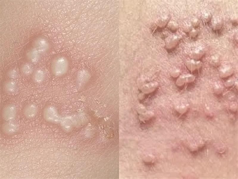 برداشتن زگیل تناسلی دست پا میخچه وخال جای بخیه|خدمات آرایشگری و زیبایی|یاسوج, |دیوار