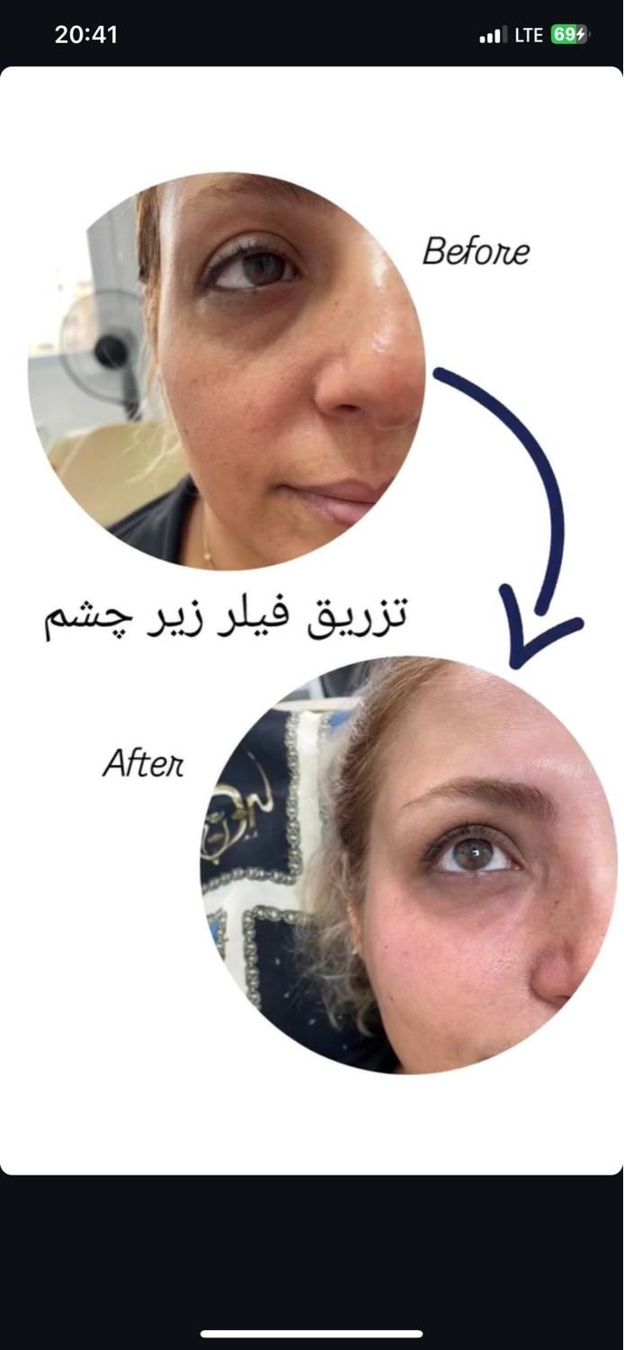 تزریق ژل مدل زاویه،گونه،چونه،لب|خدمات آرایشگری و زیبایی|تهران, امام زاده حسن|دیوار