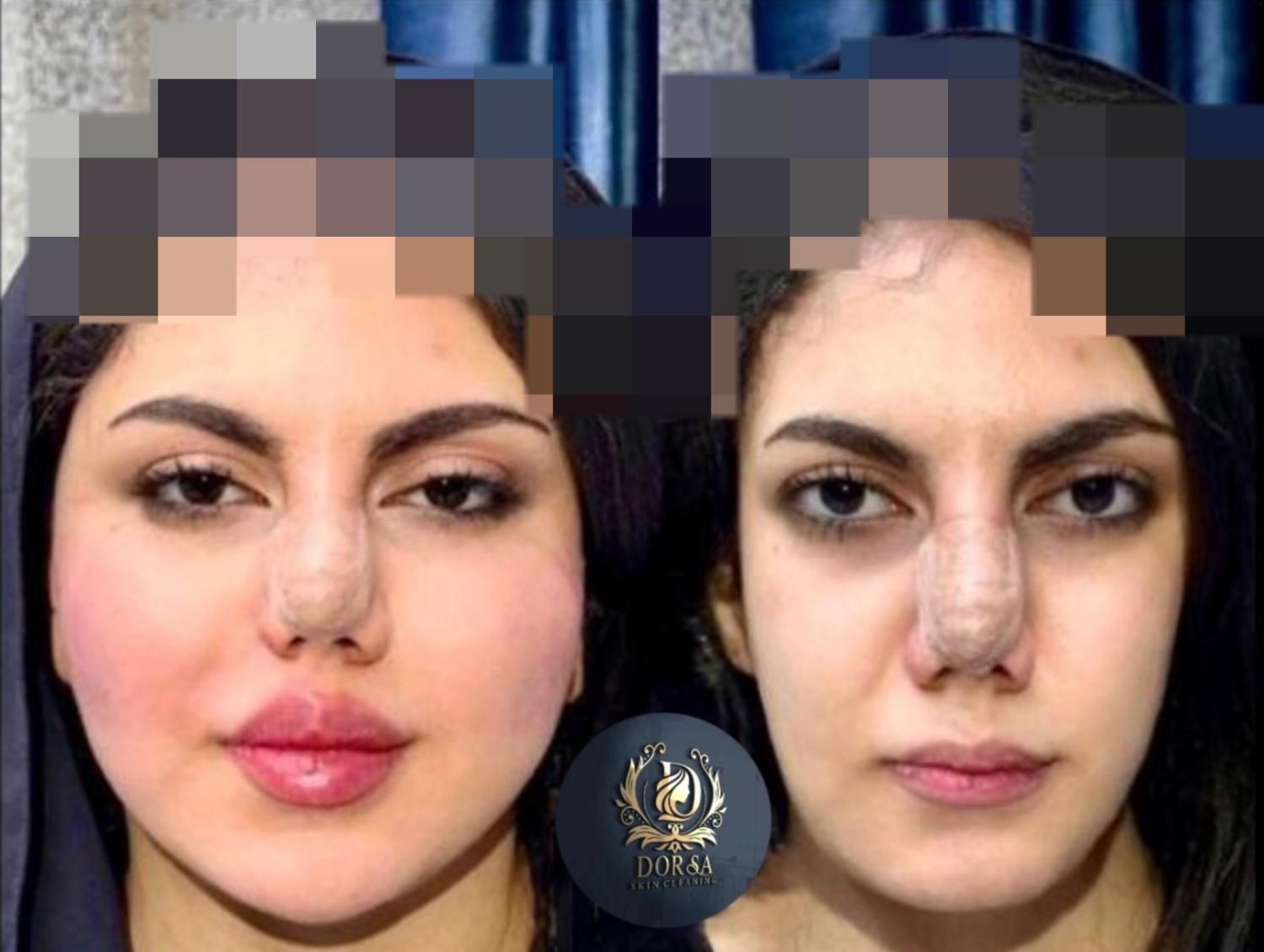 تزریق تخصصی ژل ومادلینگ خلیجی واروپایی وبوتاکس|خدمات آرایشگری و زیبایی|کرمانشاه, |دیوار