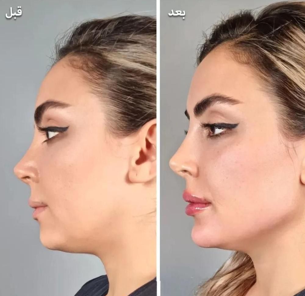 بوتاکس وژل.مزوسر   فقط۳۵۰|خدمات آرایشگری و زیبایی|کرج, بنیاد|دیوار