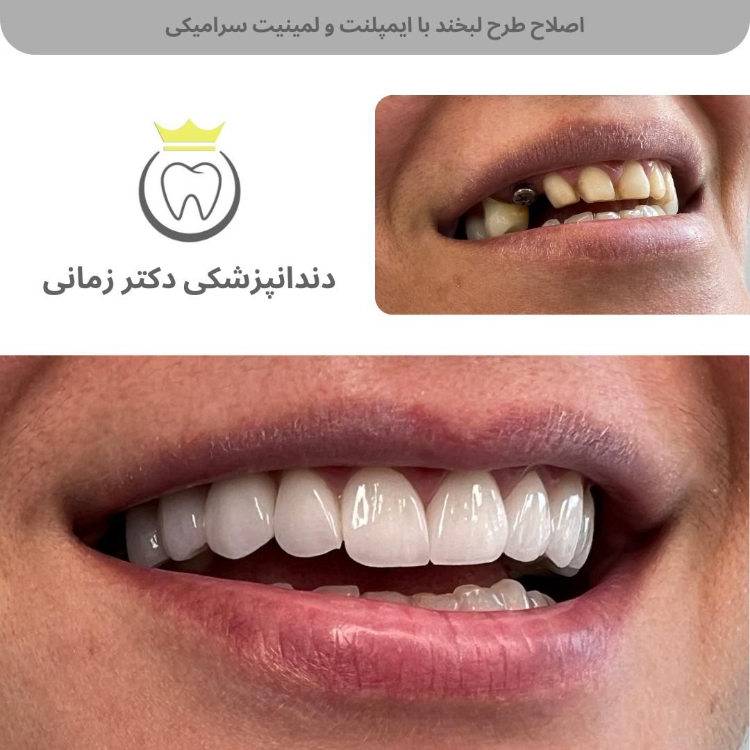 تخفیف ویژه جرمگیری و بلیچینگ (سفید کردن دندان)|خدمات آرایشگری و زیبایی|تهران, امیریه|دیوار