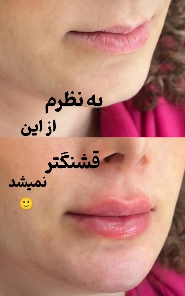 جشنواره تزریق ژل و بوتاکس،فیلرلب،مزو،هایفو،آنزیم|خدمات آرایشگری و زیبایی|کرج, عظیمیه|دیوار