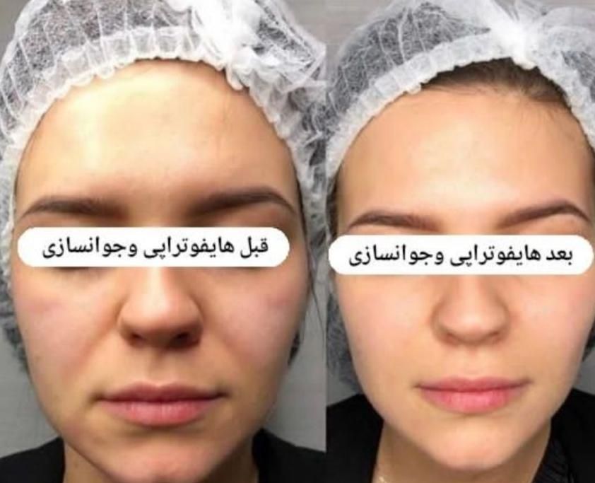 هایفوتراپی جوانسازی لیفت صورت غبغب آف به مدت محدود|خدمات آرایشگری و زیبایی|قم, شهرک قدس|دیوار