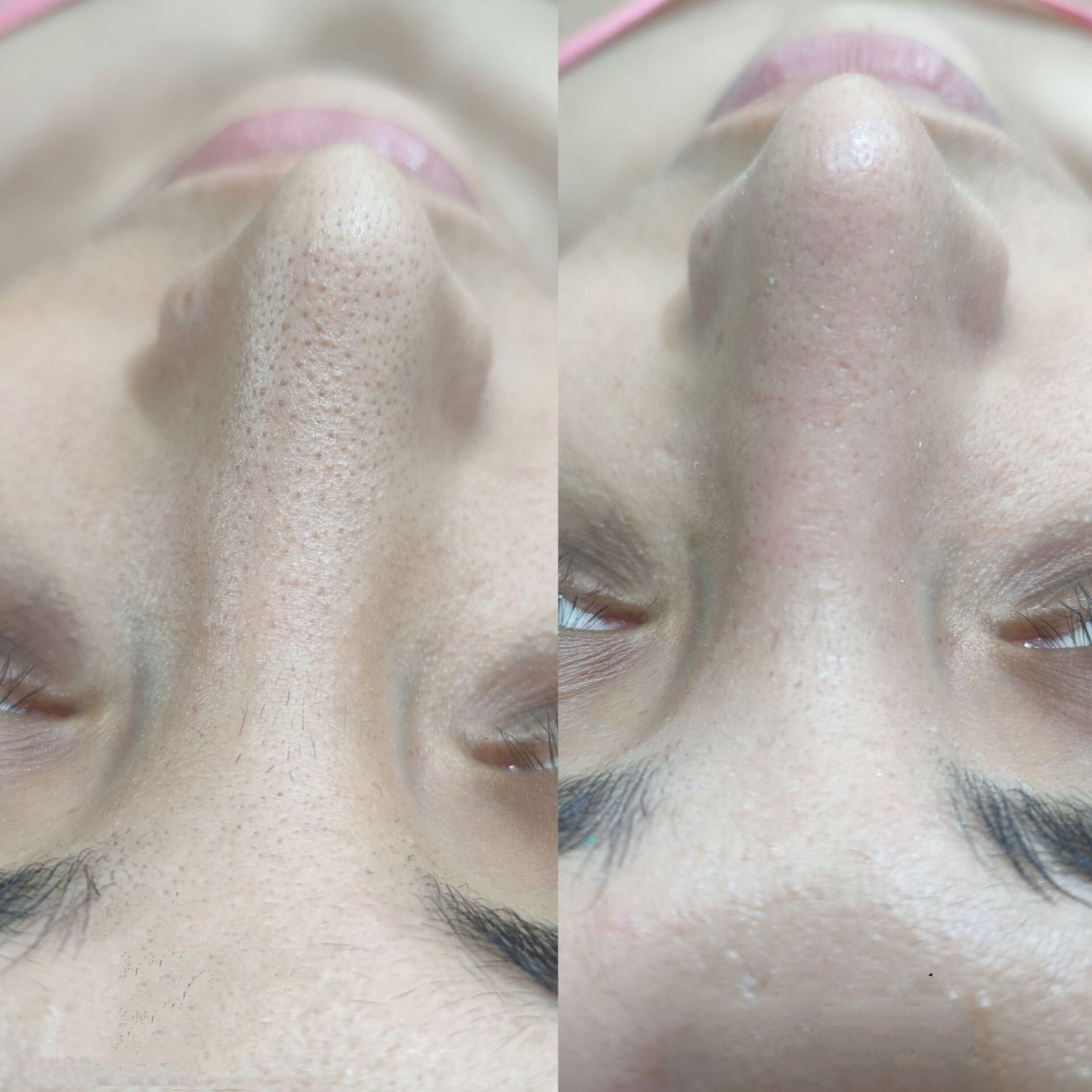فیشال و پاکسازی پوست|خدمات آرایشگری و زیبایی|شیراز, عادل آباد|دیوار