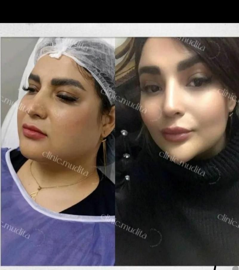 بوکالفت/ساکشن غبغب/ساکشن شکم/تزریق چربی باسن/فیلر|خدمات آرایشگری و زیبایی|تهران, صادقیه|دیوار