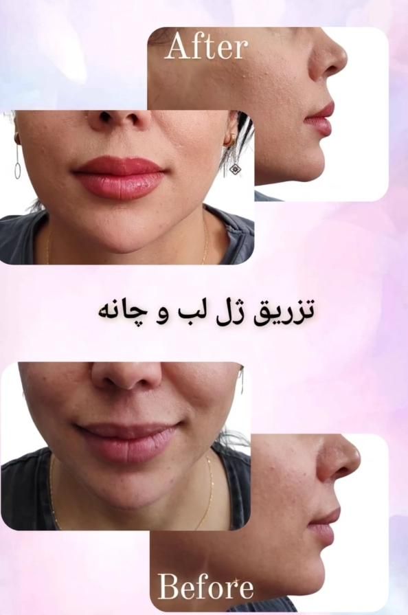 جشنواره تزریق ژل و بوتاکس و PRP برداشت خال|خدمات آرایشگری و زیبایی|تهران, بلوار کشاورز|دیوار
