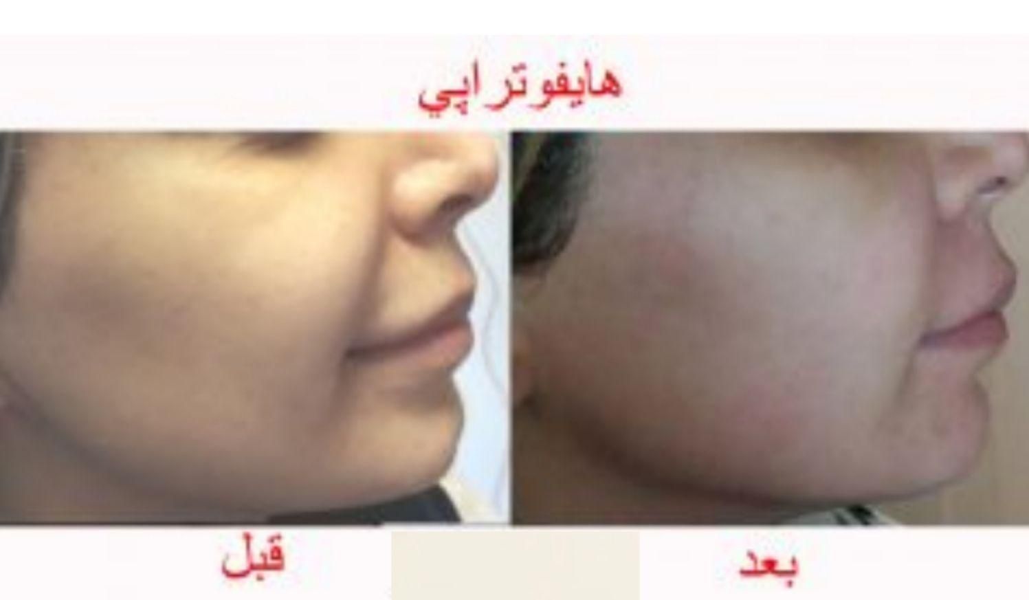 هایفوتراپی لیفت صورت رفع غبغب|خدمات آرایشگری و زیبایی|تهران, میرداماد|دیوار