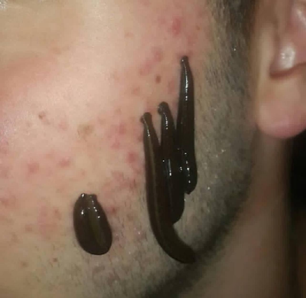 چکاب.حجامت.زالو.سم زدایی.جاانداختن رگ|خدمات آرایشگری و زیبایی|بم, |دیوار