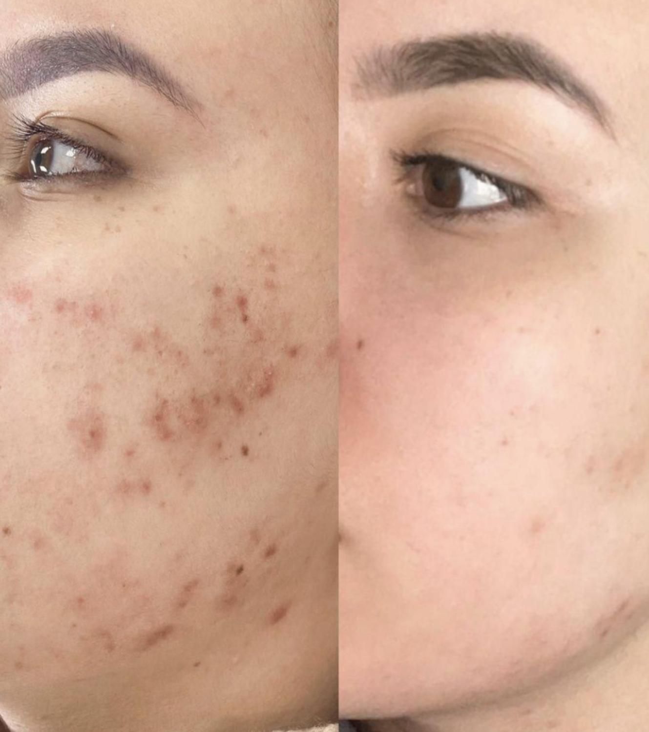 فیشیال تخصصی پوست|خدمات آرایشگری و زیبایی|سبزوار, فرهنگیان|دیوار