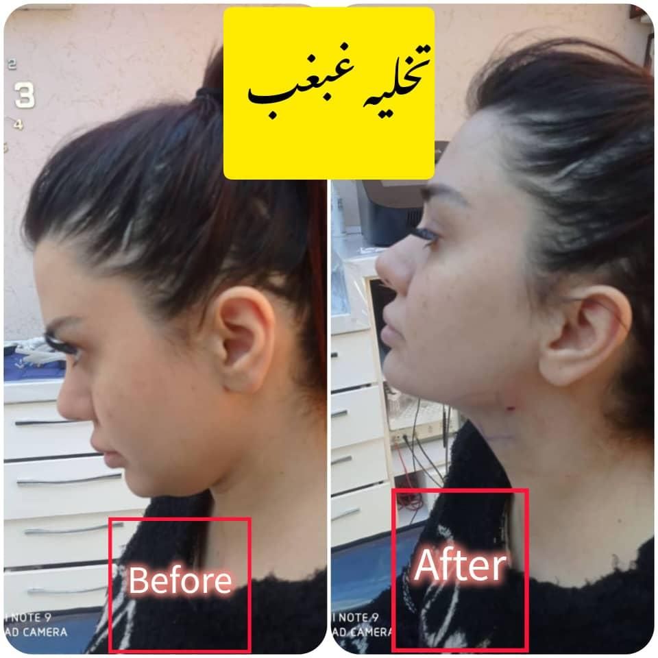 جشنواره ساکشن تخصصی غبغب و تزریق چربی اقساط|خدمات آرایشگری و زیبایی|تهران, شهر زیبا|دیوار