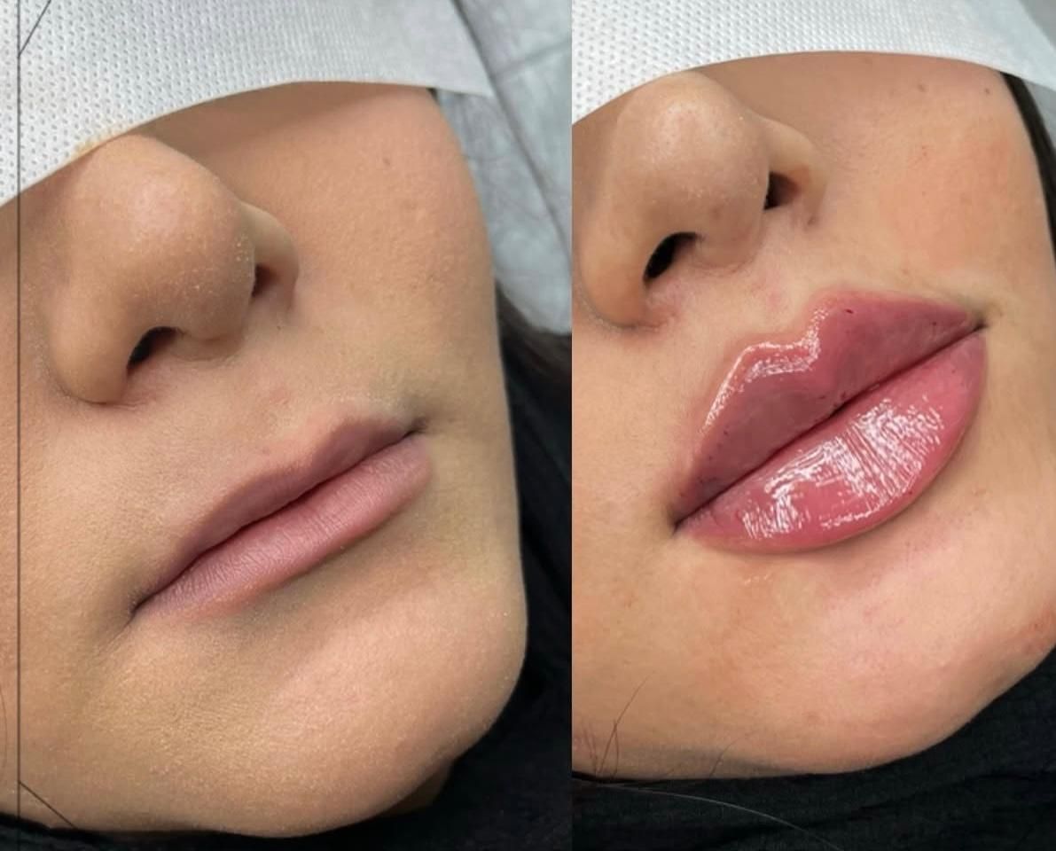 تزریق ژل و بوتاکس و کانتور صورت توسط پزشک|خدمات آرایشگری و زیبایی|فردیس, فردیس|دیوار