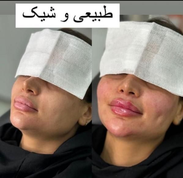 خدمات تخصصی ژل و بوتاکس|خدمات آرایشگری و زیبایی|شاهین‌شهر, فردوسی|دیوار