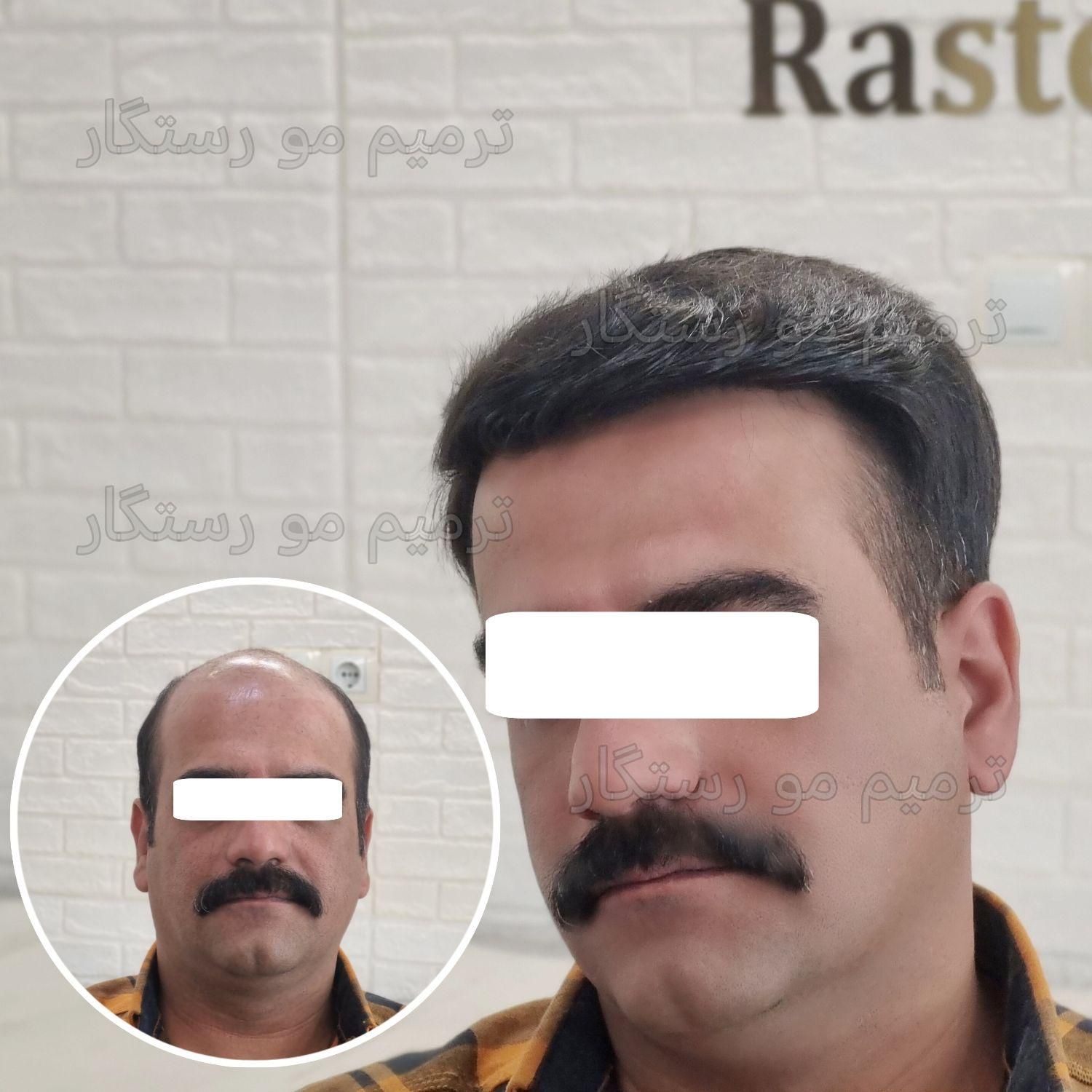 ترمیم مو /پروتز مو  / جایگزین کاشت مو و کلاهگیس|خدمات آرایشگری و زیبایی|اصفهان, آبشار|دیوار