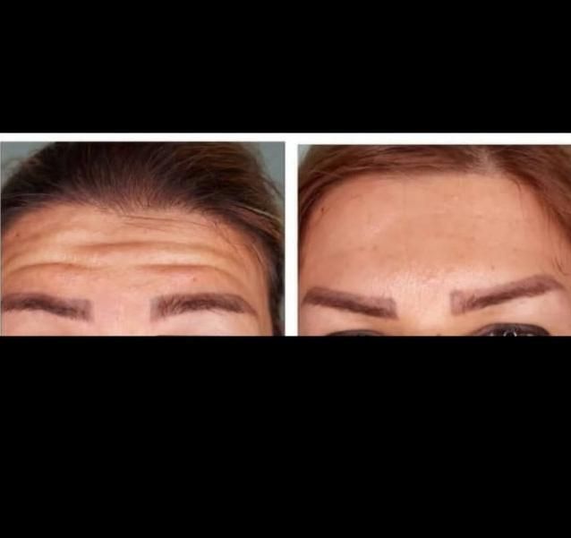 بوتاکس صورت و زیر بغل(جشنواره)در مطب|خدمات آرایشگری و زیبایی|اصفهان, ملک‌شهر|دیوار