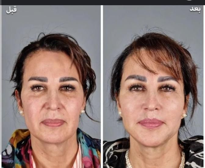 لیفت نخ معجزه جوانی و لیفتینگ صورت بدون جراحی|خدمات آرایشگری و زیبایی|شاهین‌شهر, فردوسی|دیوار