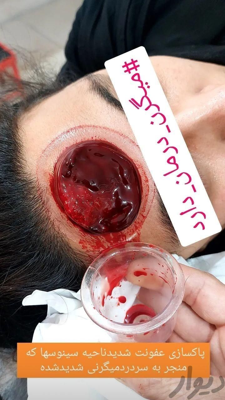 حجامت رفع مشکلات کبدی تیرگی پوست خستگی و غلظت خون|خدمات آرایشگری و زیبایی|ایلام, |دیوار