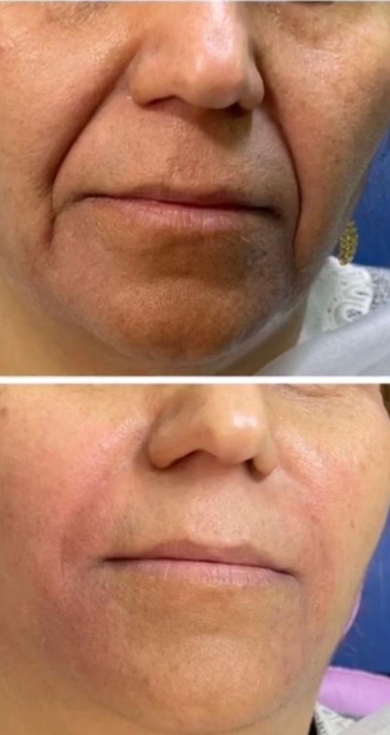 تزریق ژل لب و گونه و چانه و..(جشنواره)درمطب|خدمات آرایشگری و زیبایی|اصفهان, ملک‌شهر|دیوار
